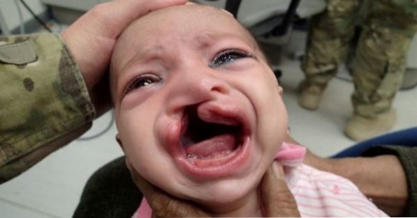 Cleft Palate: What Causes and How to Treat?