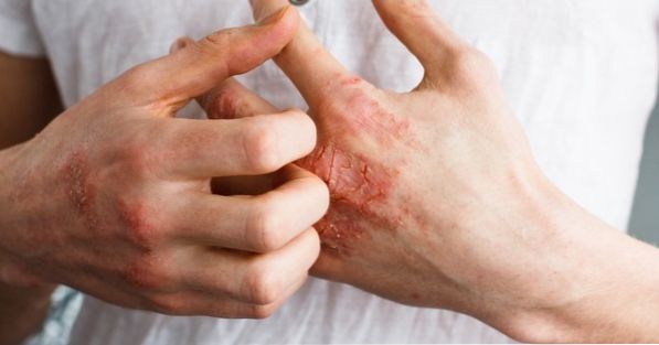 Can fungi on the skin cause ringworm?