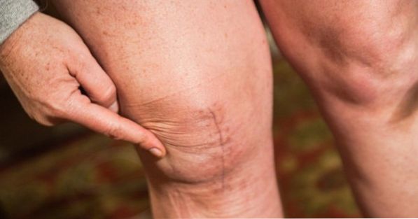 Eau de genou: Quels sont les symptômes et comment la traiter?