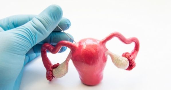 Isterectomia: come funziona la chirurgia di rimozione dell'utero?