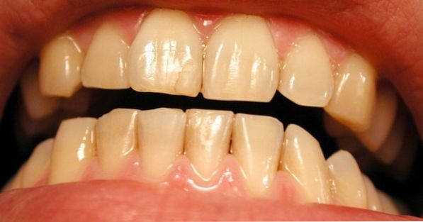 My gums are bleeding, what can I do and what should I do?