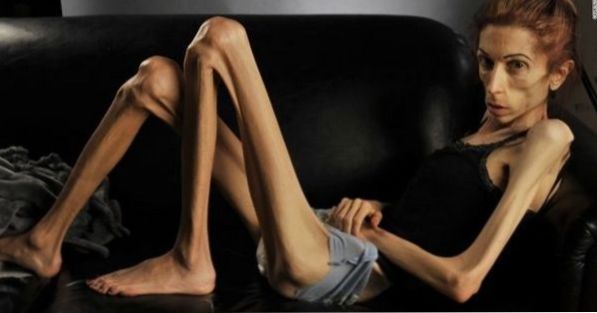 Cos'è l'anoressia e quali sono le sue cause?