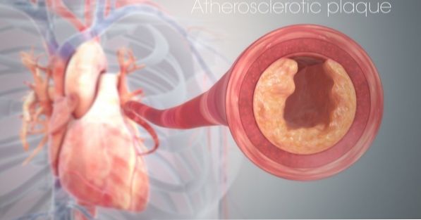 What causes atherosclerosis?