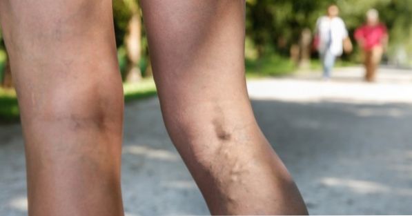 What are the symptoms of venous insufficiency?