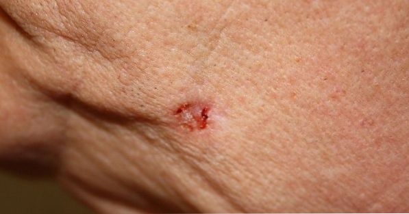 What are the symptoms of basal cell carcinoma?