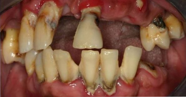 Was sind die Symptome von Mundkrebs?