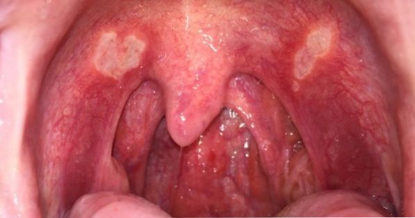I have sores in my mouth, what can it be?